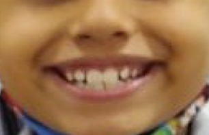 A mi hijo(a) le Rechinan los dientes