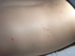 Mi Hijo tiene molusco contagioso