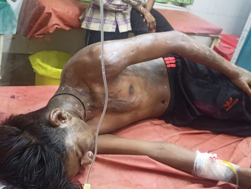 Acid Attack in Dhamtari: घायल नाबालिग का अस्पताल में इलाज