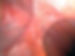 Image showing intra-abdominal adhesion—scar-like tissue bands connecting organs, commonly seen in endometriosis, causing pain, inflammation, and restricted organ movement.
