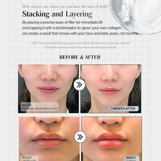 Forena Clinic Biostimulator vs Filler Comparison Table