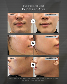 picofraxel results before and after