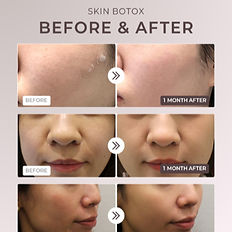 skin botox before and after