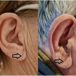 O que é o Sinal de Frank? Uma dobra na orelha que pode falar sobre o coração