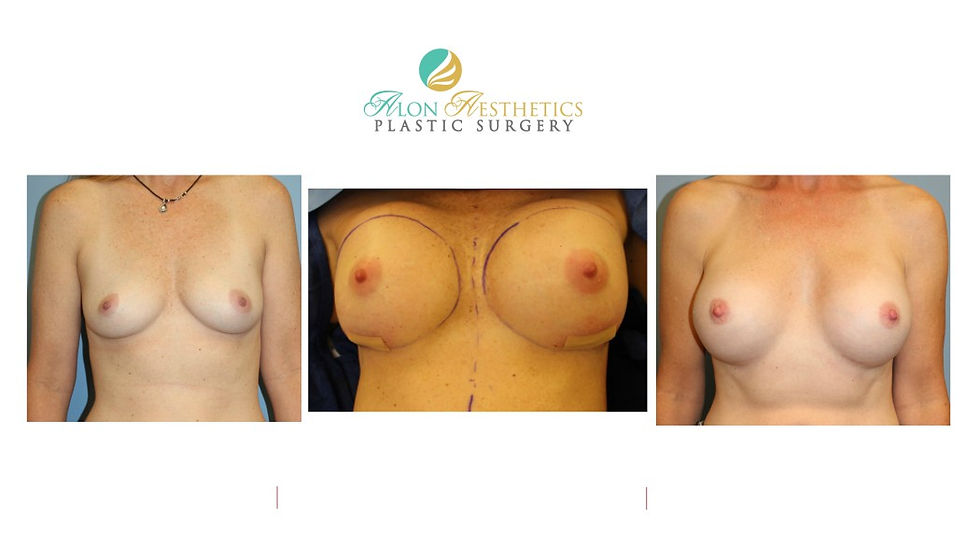 Breast Augmentation