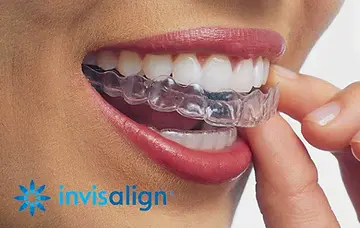 invisalign.webp