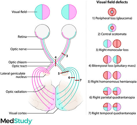 Schematic diagram of the visual tract as seen from above with areas of damage marked. There is also a series of diagrams showing the type of visual field defect resulting from each damaged spot.