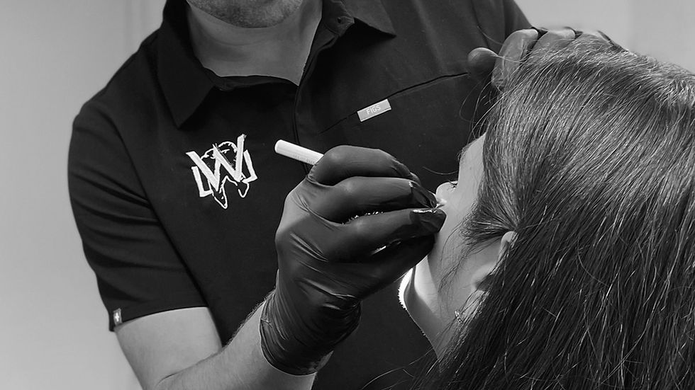 Einzeichenn der Injektionspunkte für die CMD Botox Behandlung gegen Zähnknirschen und Kieferbeschwerden