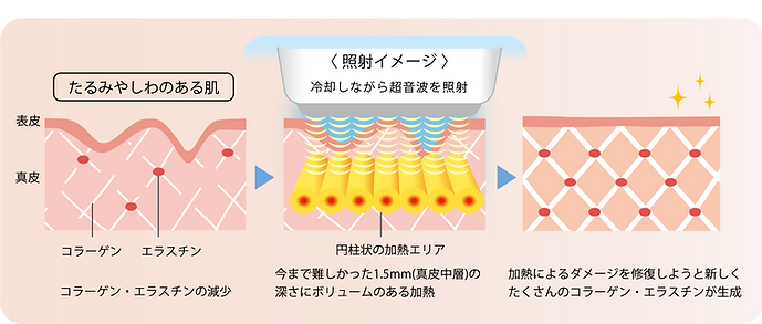 sofwave画像