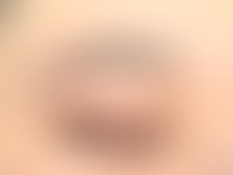 ハリウッドブロウリフトとは?