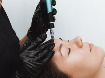 Microneedling Service