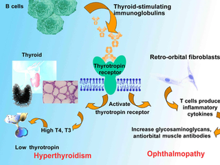 Graves Disease