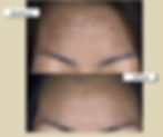 Chemical Peel 3