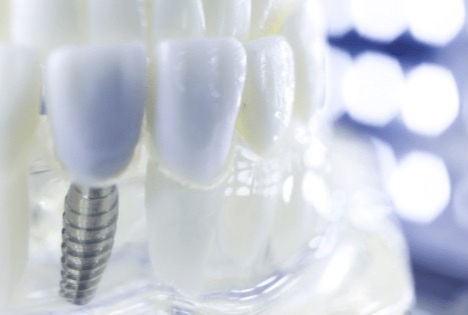 ZAHNERSATZ 2.0: MODERNE IMPLANTATPROTHETIK REVOLUTIONIERT DAS LÄCHELN