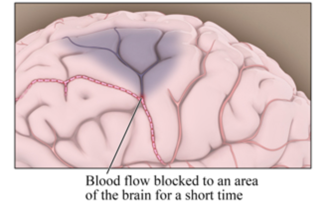 Transient blockage of blood to brain