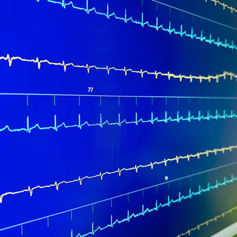 Holter EKG, 24 h EKG, 