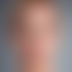 Understanding Ablative Laser Therapy: What to Expect During Treatment