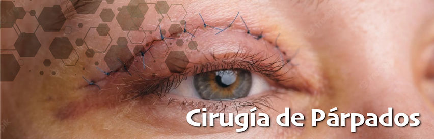 Blefaroplastia.jpg