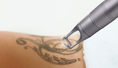 LASER TATTOO REMOVAL .jpg