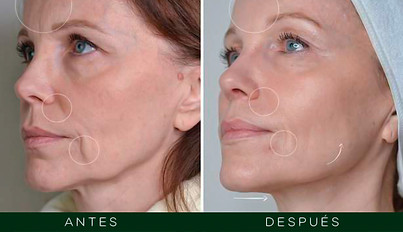 RÊVE Armonización facial Guatemala