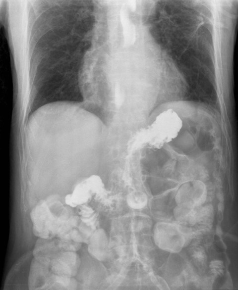 acid reflux natural treatments