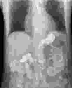 acid reflux natural treatments