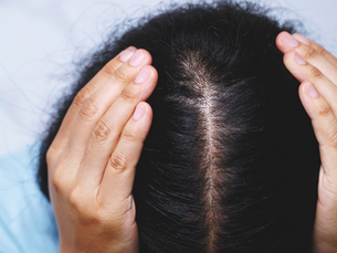 Plantas que elimina caspa