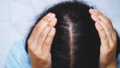 Plantas que elimina caspa