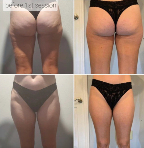 Legs 2 Treatments 6-20-22.png