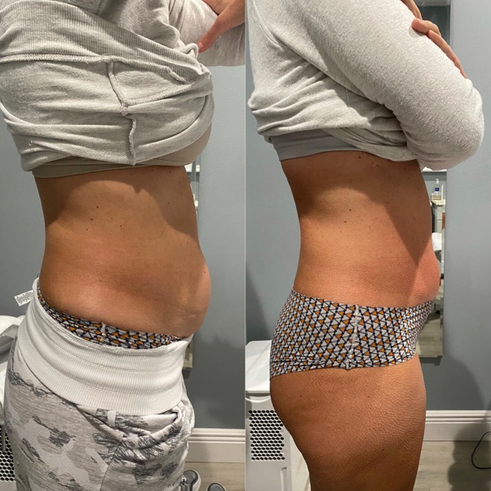 Core 1 treatment 6-20-22.png