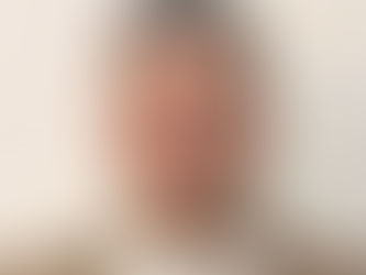 ما هو علاج دوالي الساقين بالليزر؟