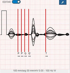Medidas de ECG2.JPG