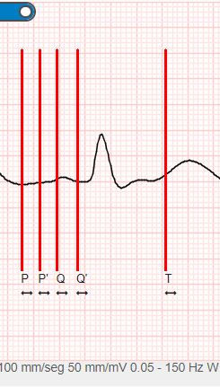 Medidas de ECG.JPG