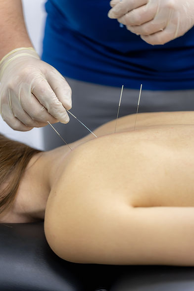 Dry needling treatment performed by a physiotherapist
