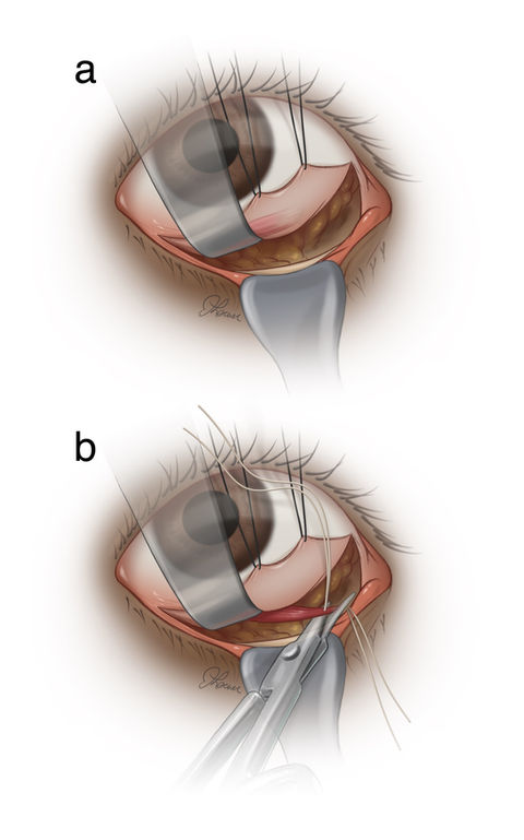 Transcaruncular / transconjunctival