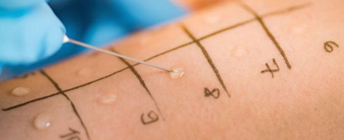 Teste de alergia - Prick teste