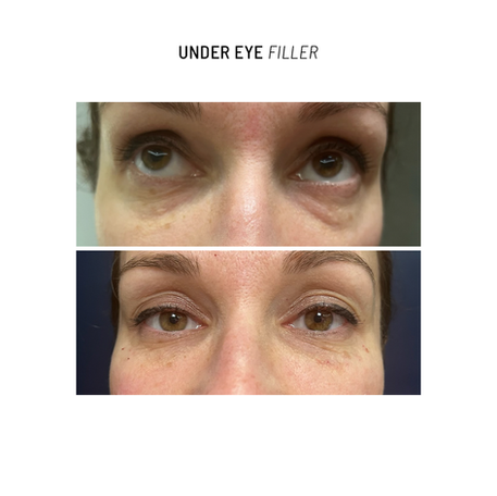 Under-eye filler treatment to smooth hollows and reduce dark circles