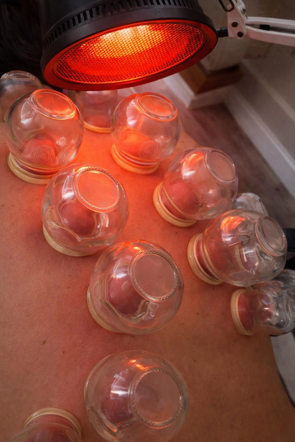 cupping therapy and Lamp TDP