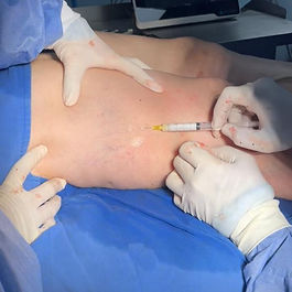 Escleroterapia 