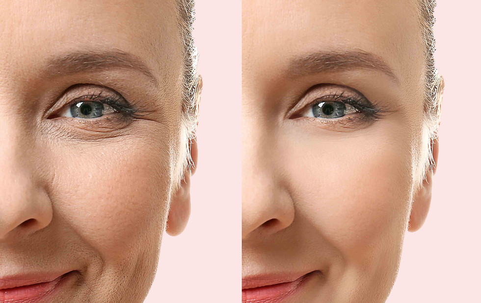 Micro Needling Pre and Post