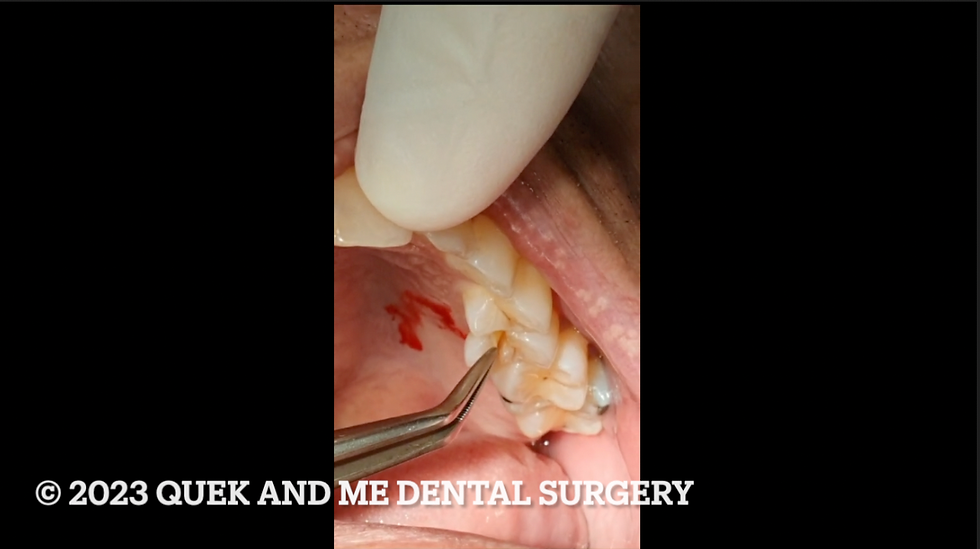 Navigating Tooth Restoration: A Comprehensive Guide to Treating a Cracked Tooth with a Mobile Palata