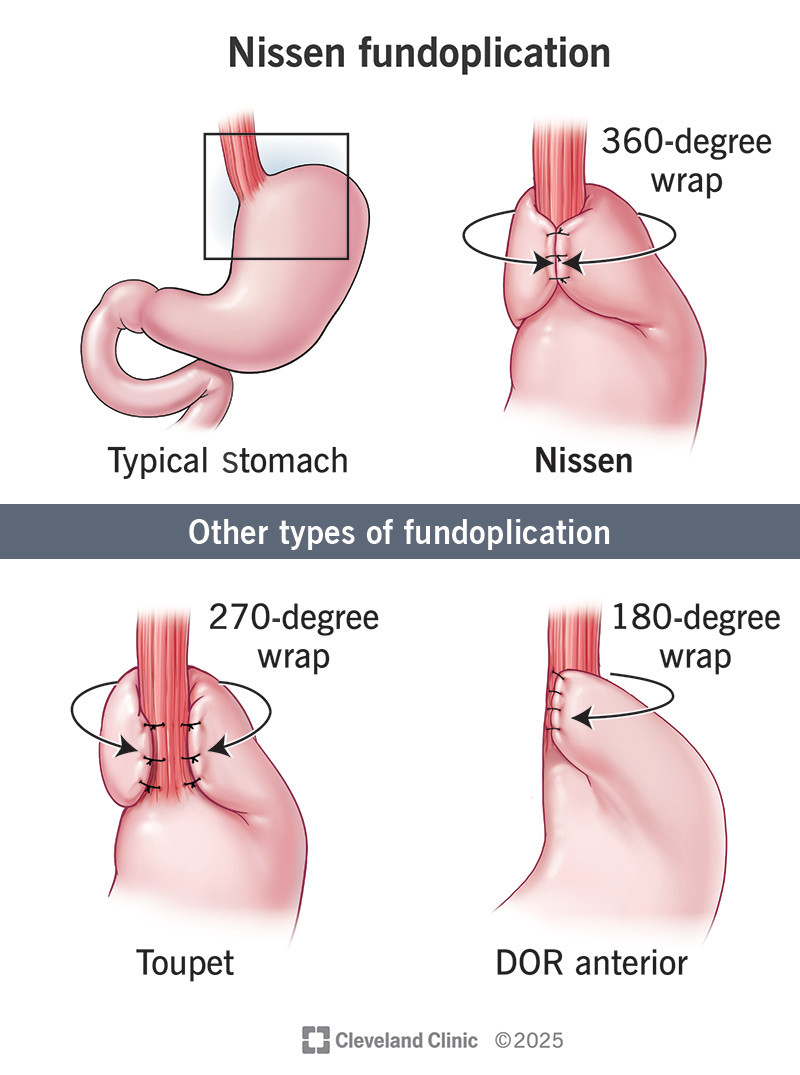 Funduplicatura de Nissen Laparoscópica (Cirugía antirreflujo)