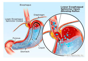 Integrative Approaches To Gastroesophageal Reflux Disorder (GERD)