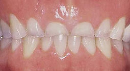 bruxism.jpg