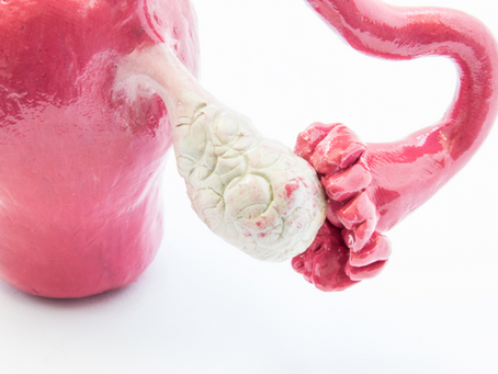 What is Ovarian Cyst Hemorrhagic? Causes and Treatment