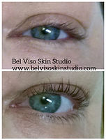 acne facial buffalo ny