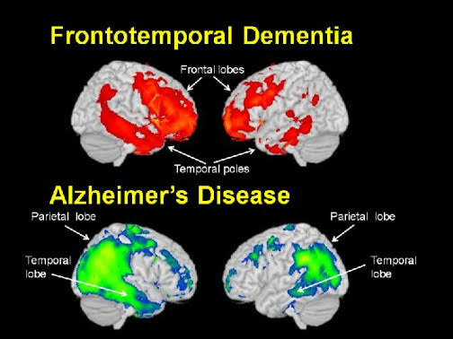 Comparativo recreado de cerebro Demencia Frontotemporal contra los efectos del Alz Heimer 