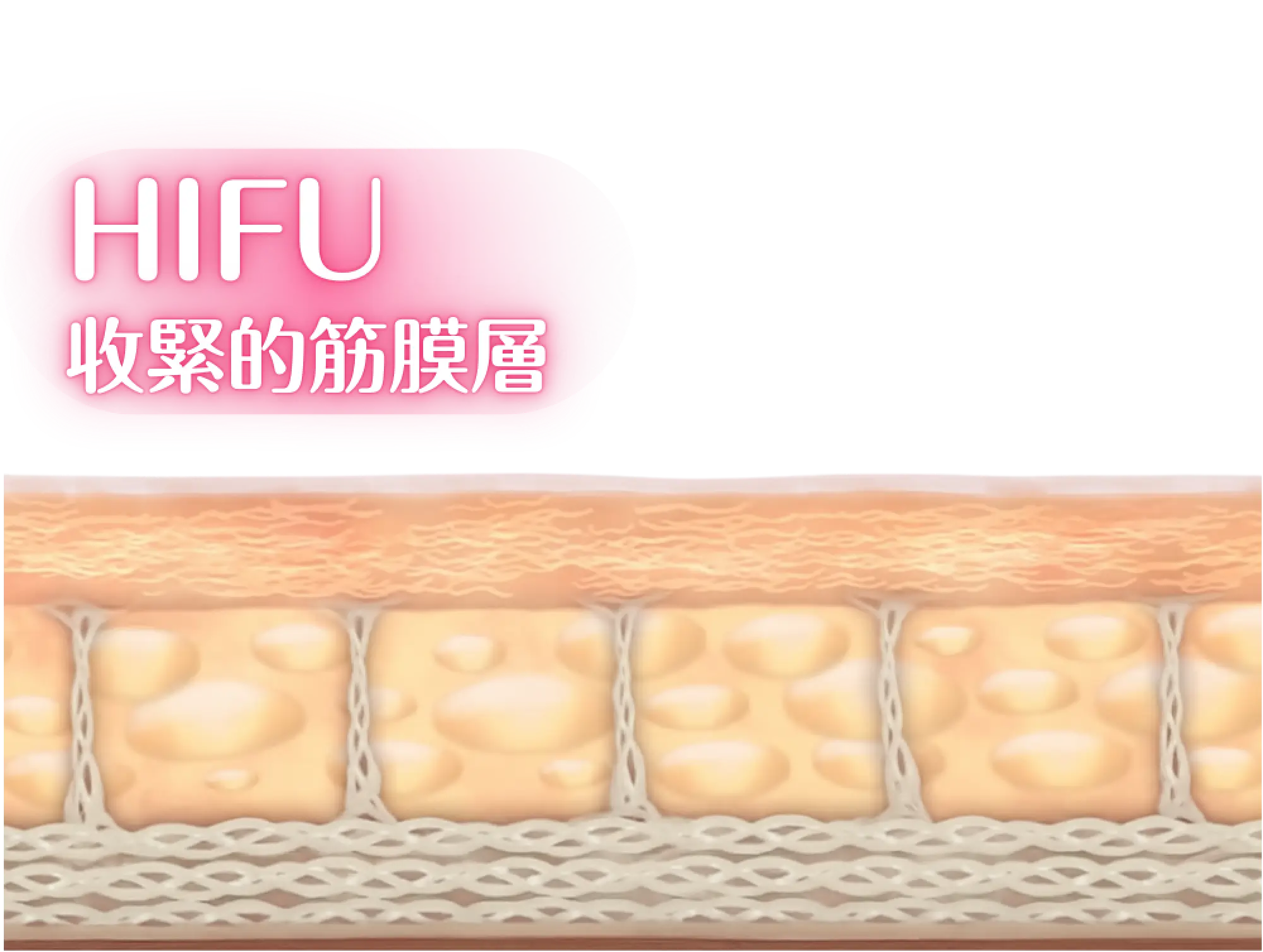HIFU .webp