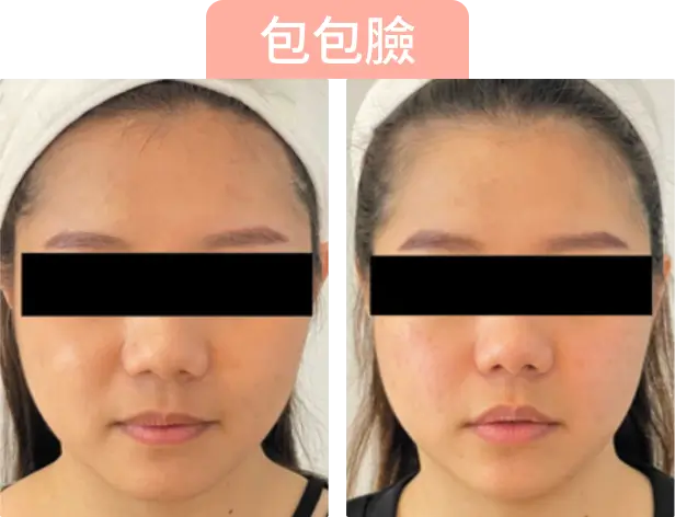 兩張女性面部照片的對比，顯示Onda Pro治療後效果。上方有「包包臉」的字樣。