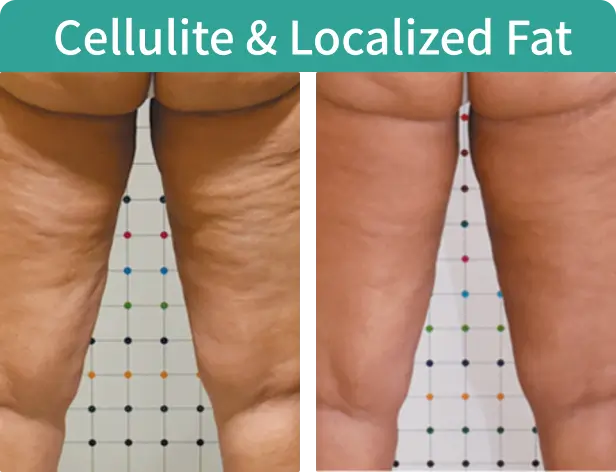  Cellulite & Localized Fat-2.webp